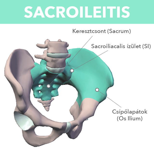 Csípőfertőző gyulladás, A csípő-keresztcsonti ízület gyulladása (sacroileitis)