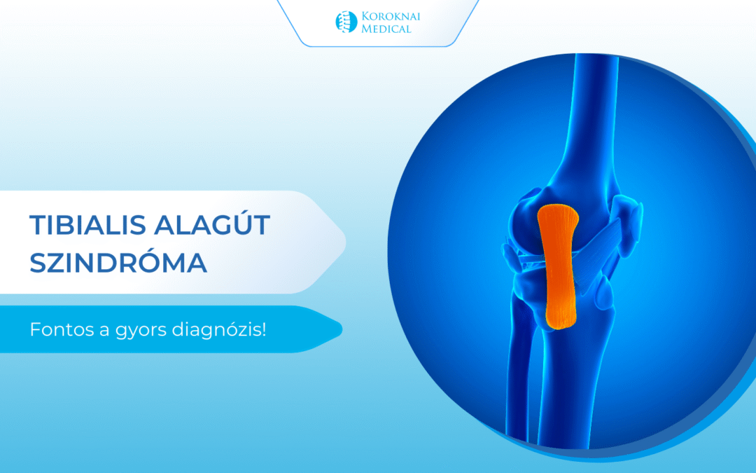 Tibialis alagút szindróma